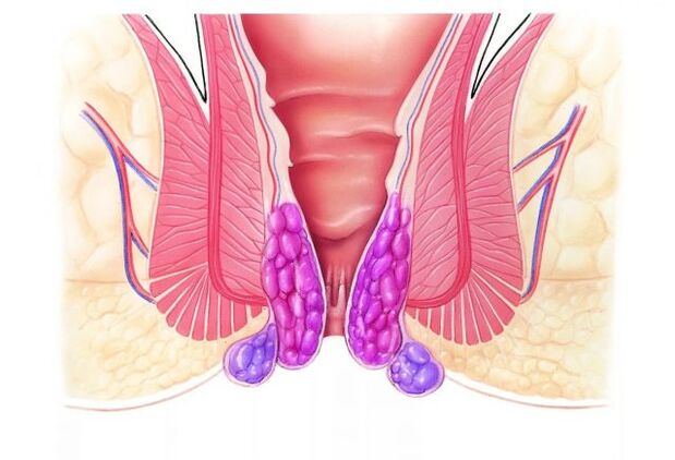 Gelarex introdúcese rectal usando o aplicador