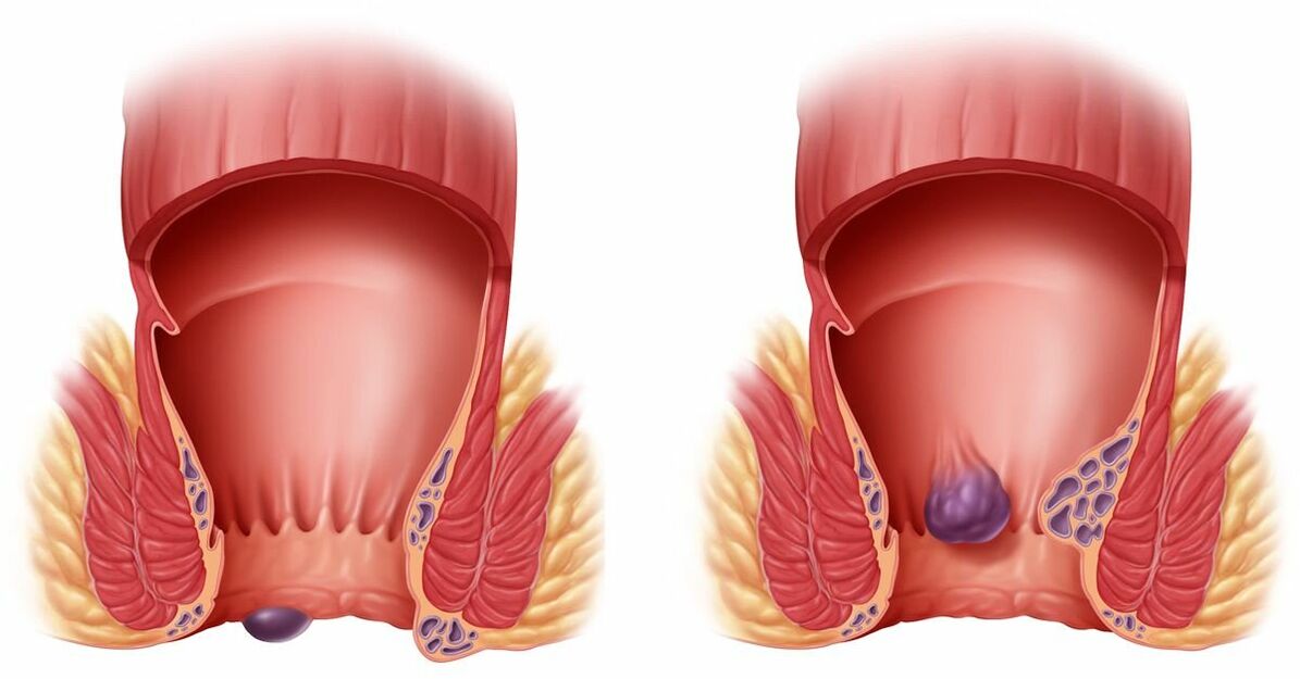 ZXCVBNMQWORT axuda con hemorroides internas e externas